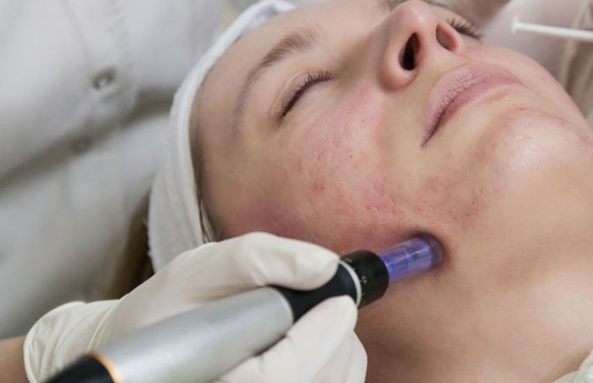 Derma Pen,www.serpilnurguzellik.com.tr